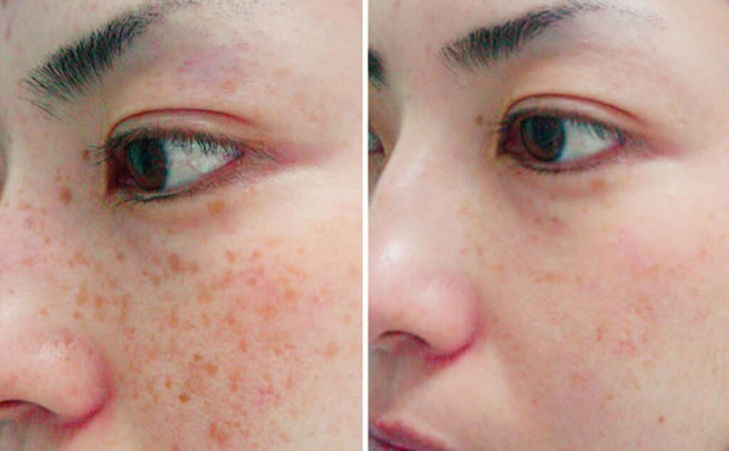 Treating Hyperpigmentation on Face